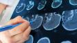 3Д скенирање мозга може повећати тачност дијагнозе АДХД-а